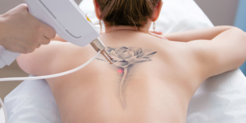 Laser tattoo removal