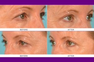 Upper eyelid blepharoplasty