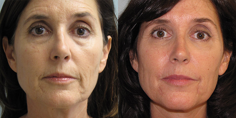 Upper and Lower blepharoplasty