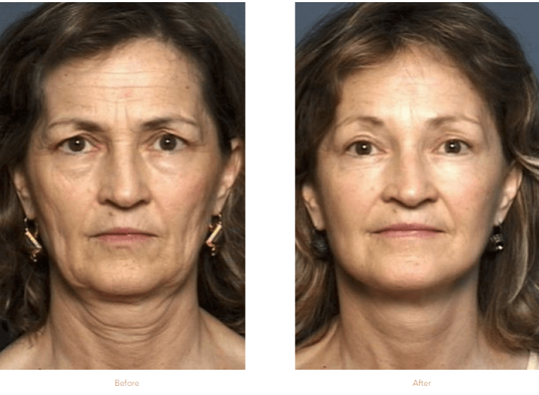 Upper and Lower blepharoplasty
