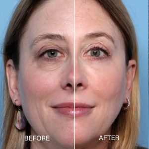 Blepharoplasty surgery near me