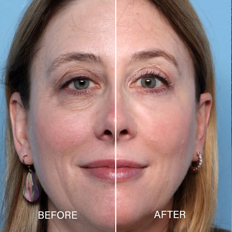 Blepharoplasty surgery near me