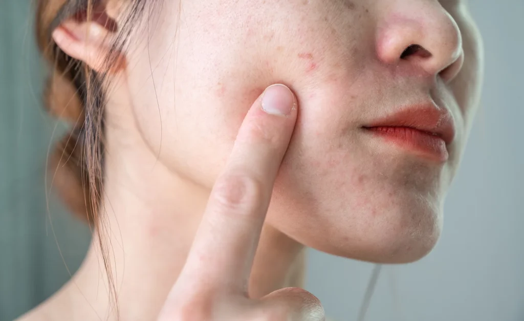 Broken blood vessels on face