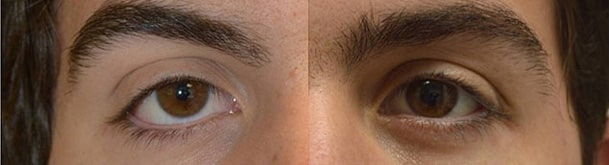 Lateral Canthoplasty