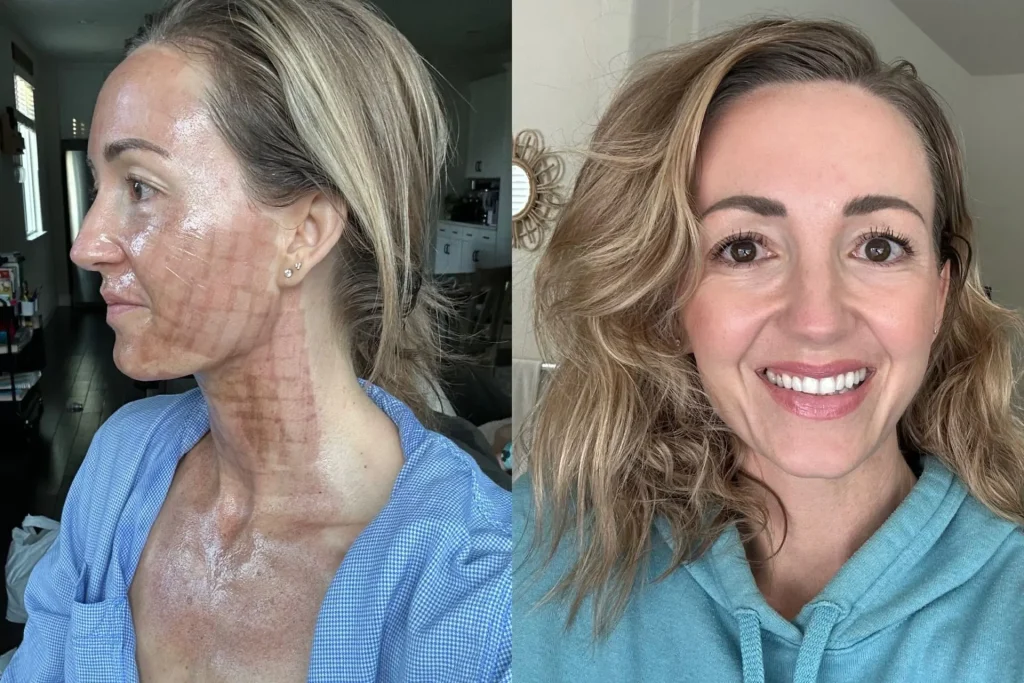 CO2 Laser resurfacing