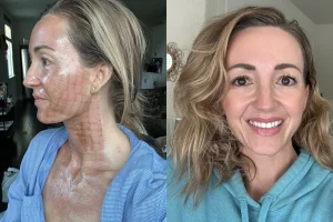 CO2 Laser resurfacing