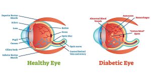 Diabetic retinopathy