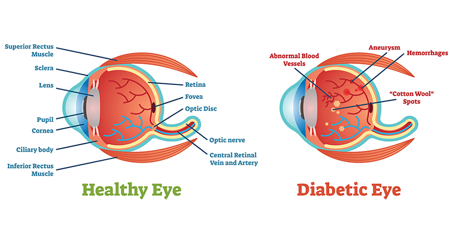 Diabetic retinopathy