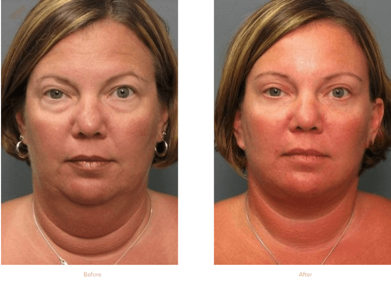 Upper and Lower blepharoplasty