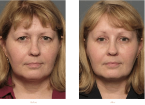 Upper and Lower blepharoplasty