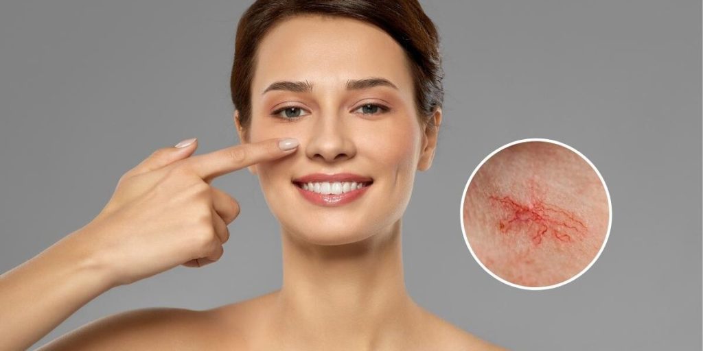 Spider veins on face treatment
