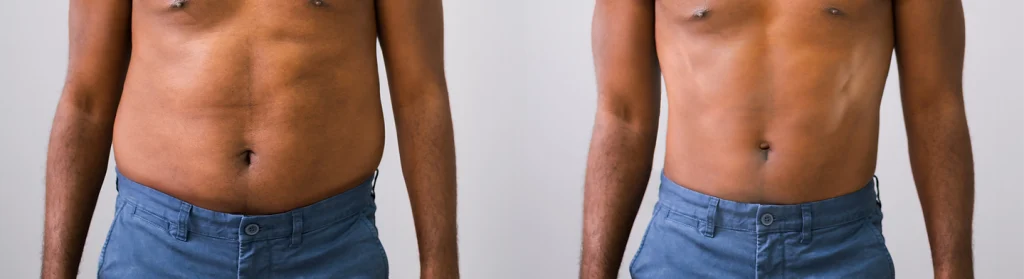 Fat dissolving injections