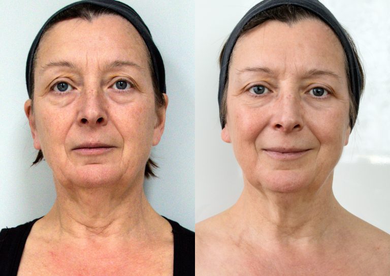 Laser Face Lift