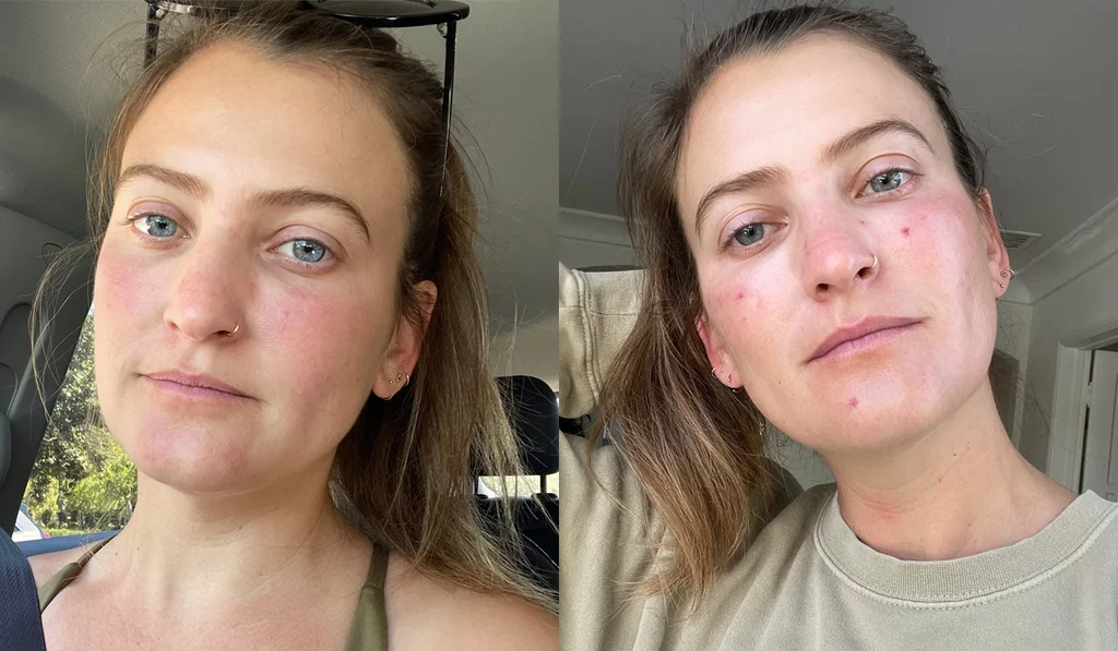 Spider veins on face treatment