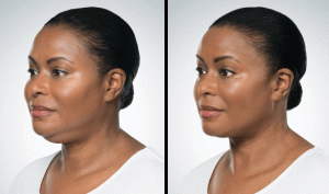 kybella