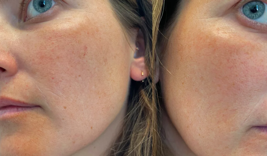 Spider veins on face treatment