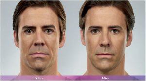 Masseter botox near me