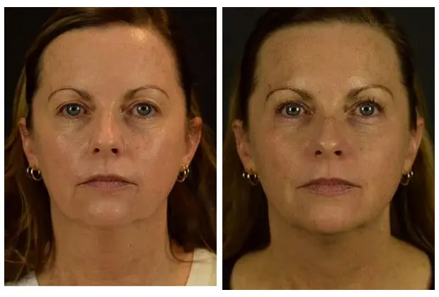 Facial threading