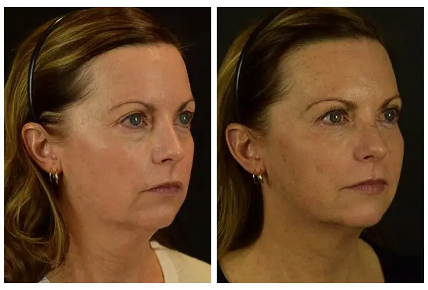 Facial threading