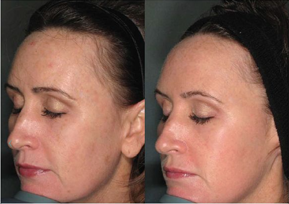 Laser Face Lift
