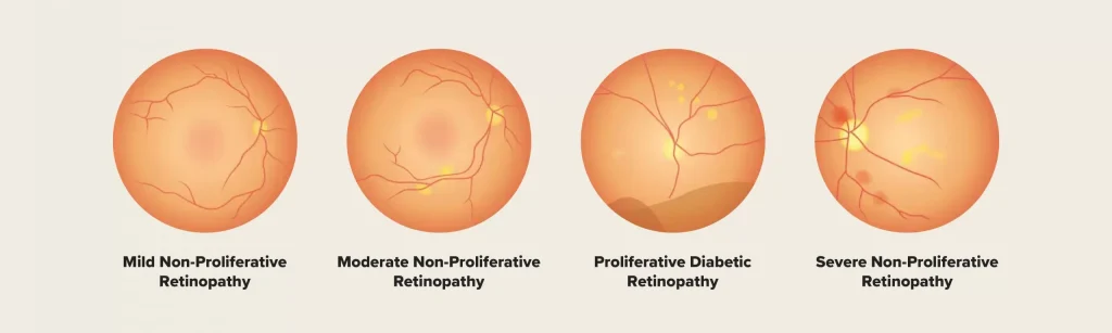 Diabetic retinopathy
