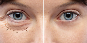 Eyelid surgery blepharoplasty