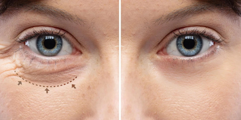 Eyelid surgery blepharoplasty