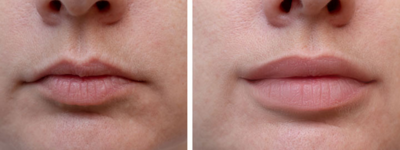Lip filler