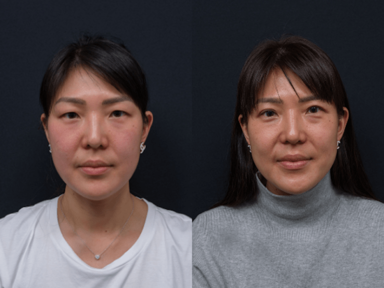Double eye lid surgery