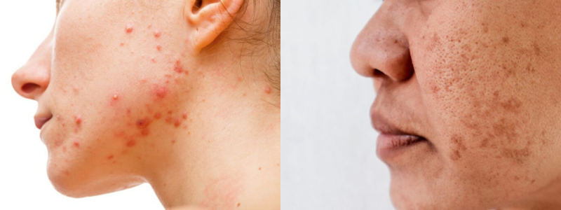 Carbon laser facial