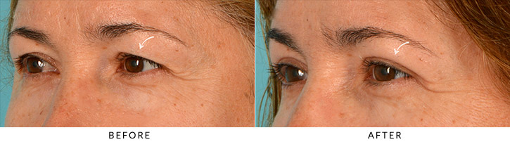 Upper eyelid blepharoplasty