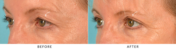 Upper eyelid blepharoplasty
