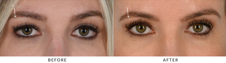 Upper eyelid blepharoplasty