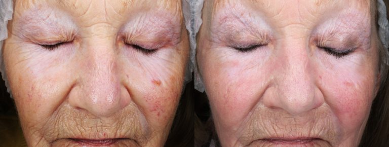 CO2 Laser resurfacing