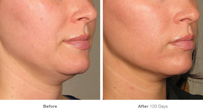 Laser skin tightening near me