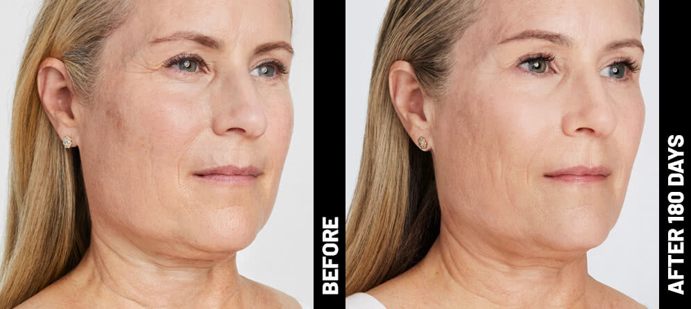 Ultherapy cost