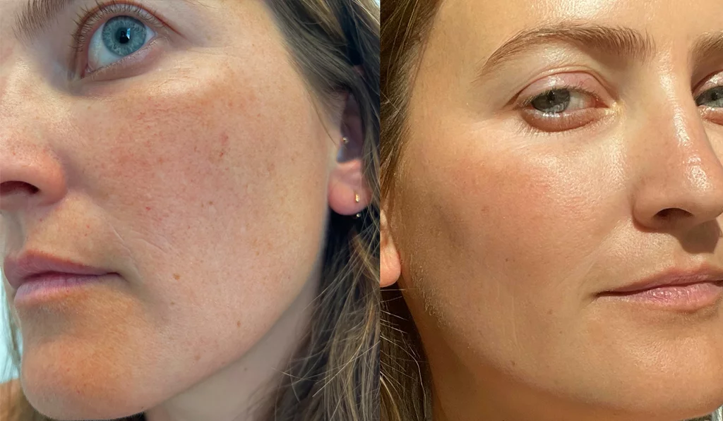 Spider veins on face treatment