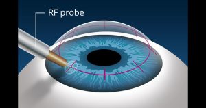 Presbyopia correction surgery