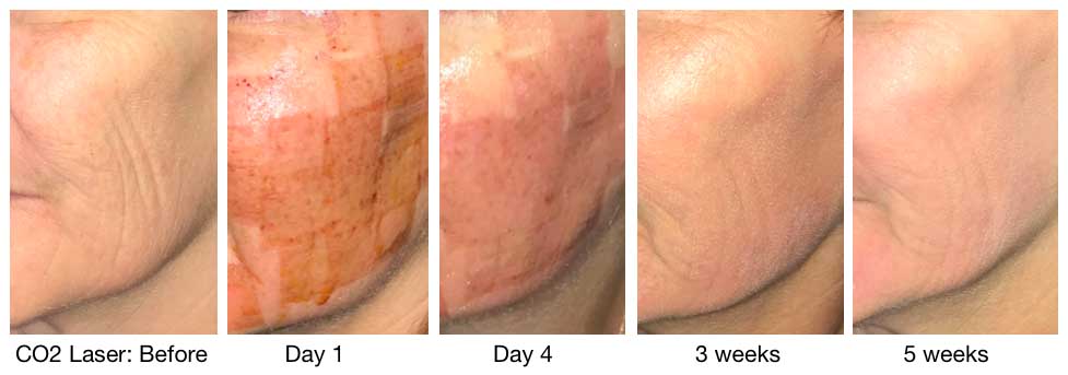 CO2 Laser resurfacing