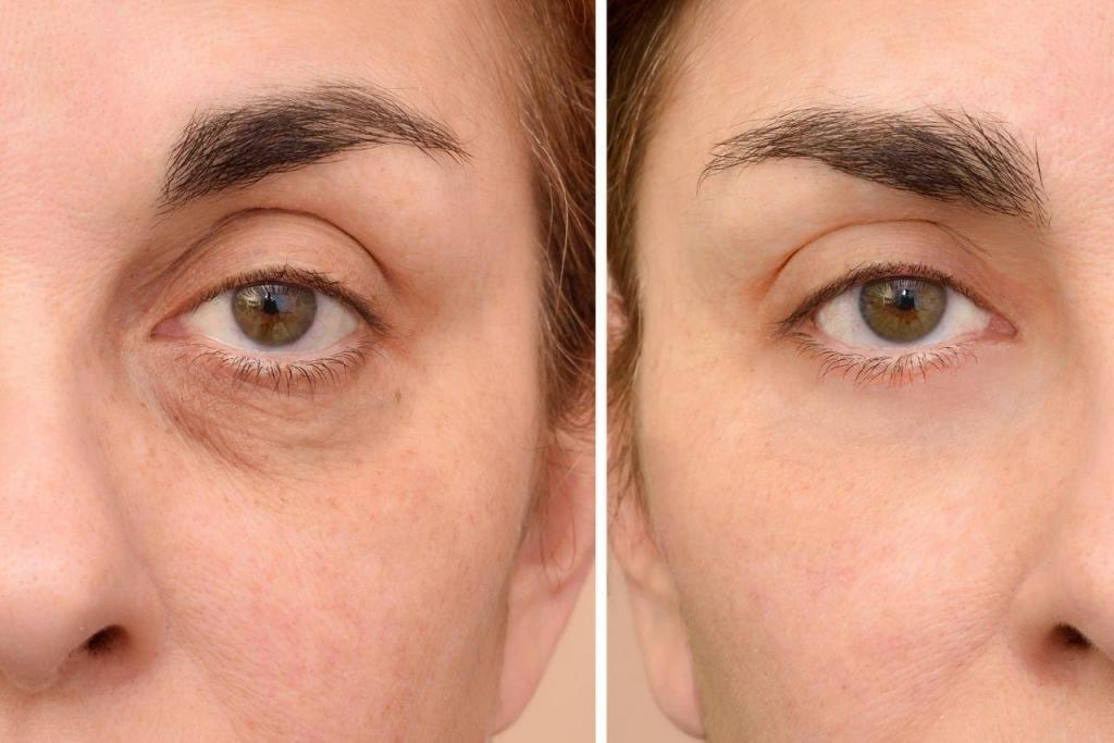 Under eye filler