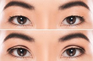 Double eye lid surgery