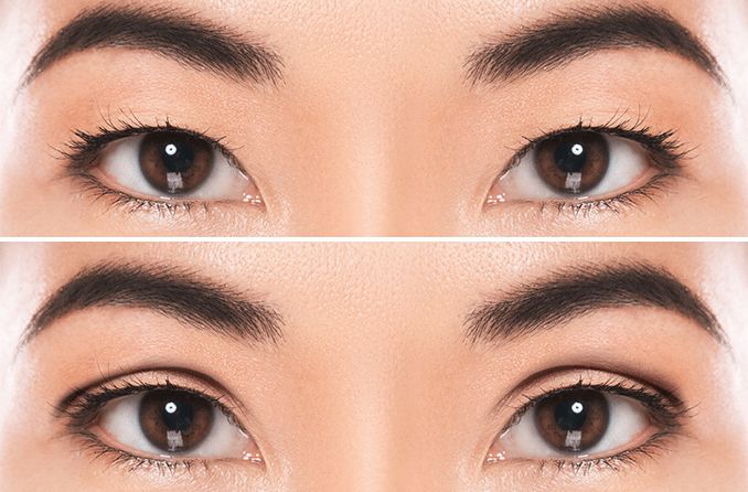 Double eye lid surgery