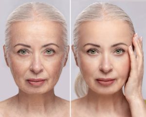 Facelift before and after