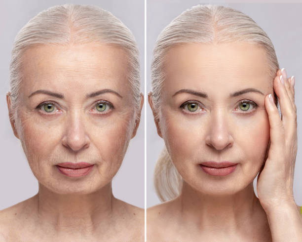 Facelift before and after