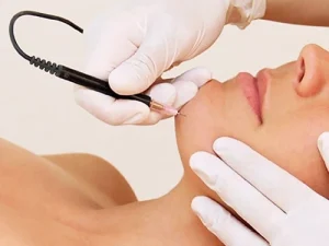 Electrolysis hair removal
