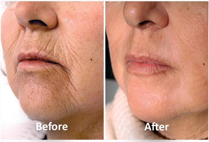 Laser skin tightening near me