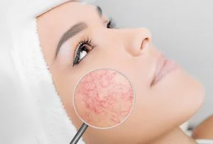 Broken blood vessels on face