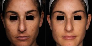Picosure laser near me
