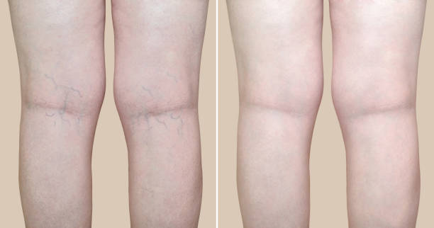 laser vein removal near me