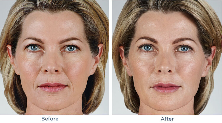 Juvederm